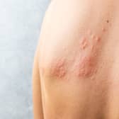You should get advice from 111 as soon as possible if you think you have shingles