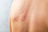 You should get advice from 111 as soon as possible if you think you have shingles