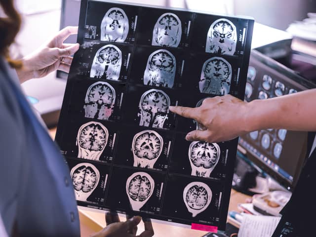 Lecanemab is designed to target and clear a protein called amyloid from patient’s brains (Photo: Adobe)