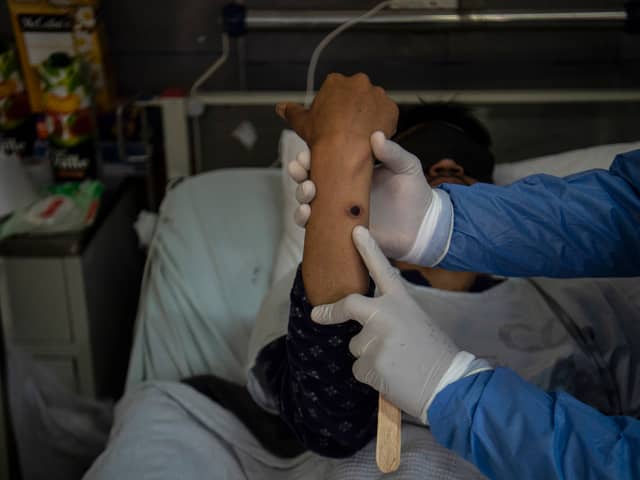 A doctor checks on a patient with sores caused by a mpox infection. (Photo: ERNESTO BENAVIDES/AFP via Getty Images)