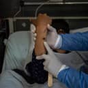 A doctor checks on a patient with sores caused by a mpox infection. (Photo: ERNESTO BENAVIDES/AFP via Getty Images)