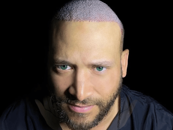 Aslı Tarcan Clinic is a leading destination for anyone considering hair transplant procedure in Turkey