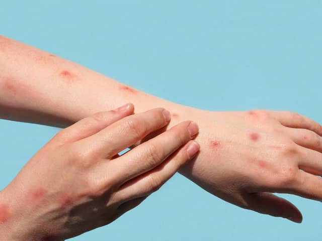 A fifth UK case of mpox Clade Ib has been found in Leeds