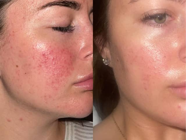 These are before and after images of Jamie, another 47 Skin user