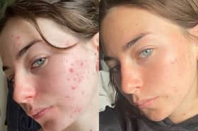 Fight breakouts with 47 Skin and the revolutionary skincare ingredient you’ve properly never heard of 