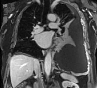 A scan of mesothelioma in the lining of the lungs