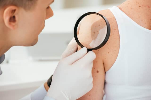 It's important to get any suspicious moles or lesions checked by your GP as early as possible.