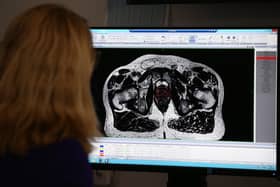 The scan of a patient diagnosed with prostate cancer