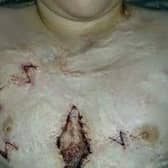 Ben suffered extensive third degree burns after a firework display at home went wrong. He has undergone 10 years of operations. (A McCabe)